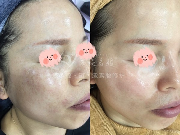 真的能行！不提取，不剝脫，涂抹就下“斑”